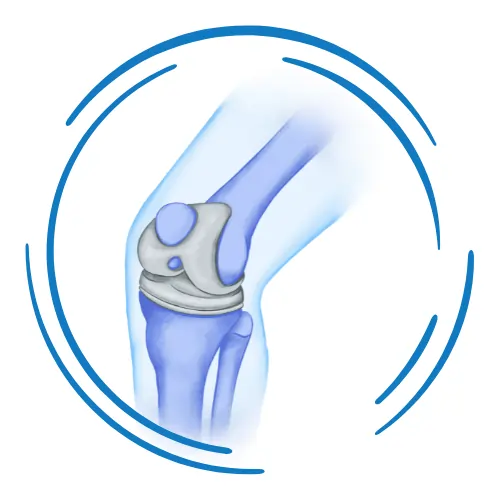 Knee Replacement Surgery (1)
